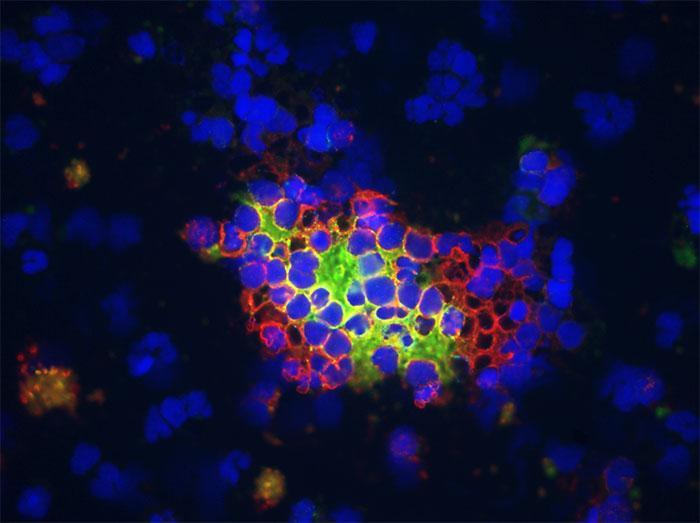 A visualisation of neuroblastoma cancer cells under a microscope